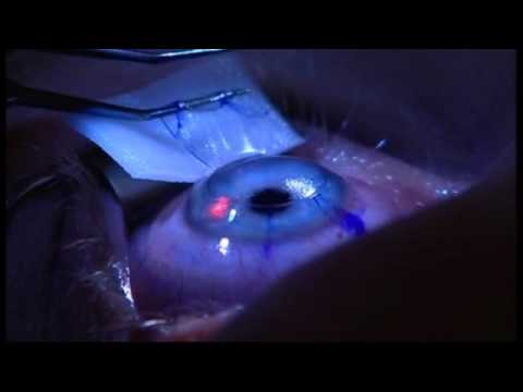 laser eye surgery dubai